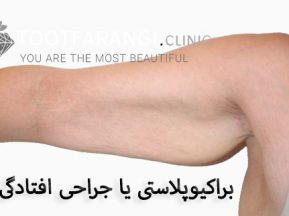 براکیوپلاستی یا جراحی افتادگی بازو