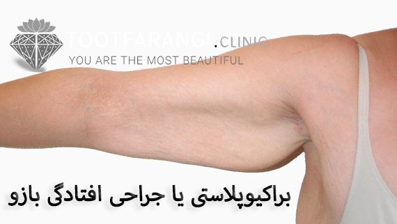 براکیوپلاستی یا جراحی افتادگی بازو