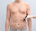 Doctor,Drawing,Lines,On,Man's,Stomach,With,Marker,Against,Light