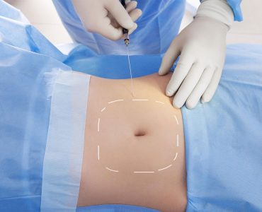 روش-لیزر-لیپولیز-ناحیه-شکم